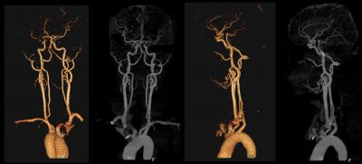 Angiographie par TDM (scanner) carotidienne Incisive montrant une imagerie détaillée des artères