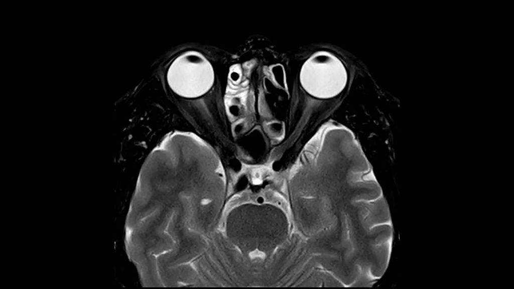 T2W mDIXON XD TSE (Water Only)