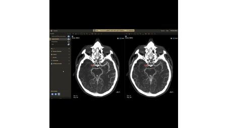 Bolus watch functionality to monitor contrast and start the CBCT acquisition at the right time​​