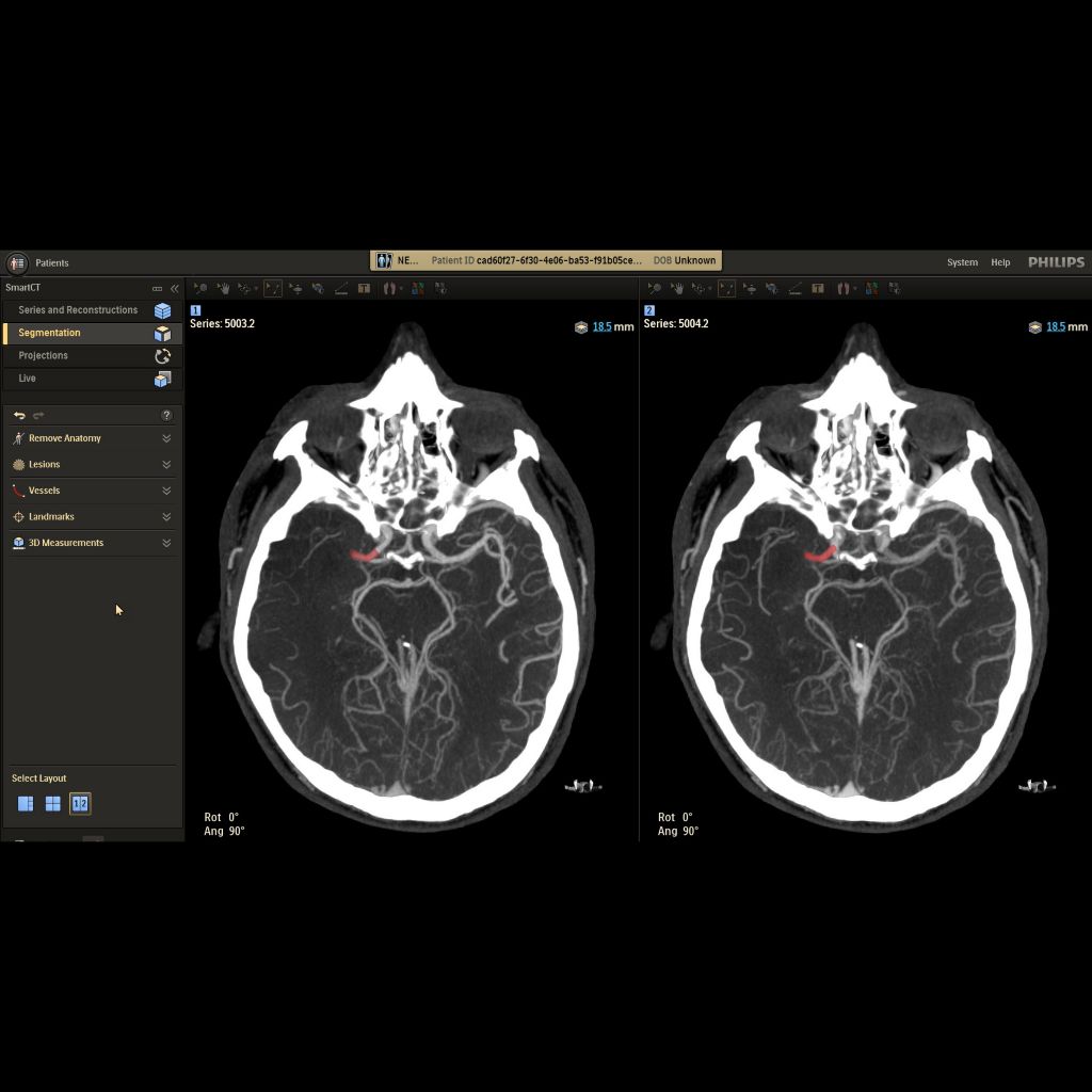 Bolus watch functionality to monitor contrast and start the CBCT acquisition at the right tim​​