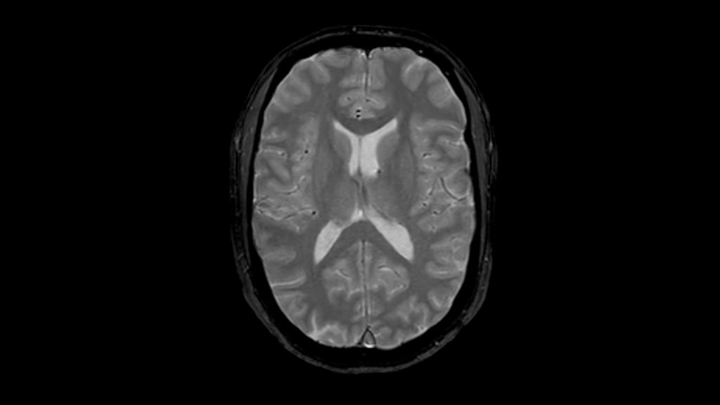 T2* FFE clinical image of the brain