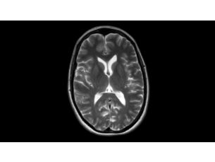 MultiVane XD - Brain MR Clinical application