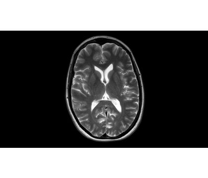 MultiVane XD Brain MR Clinical application | Philips