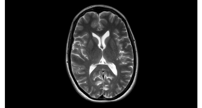 MultiVane XD Brain MR Clinical application | Philips
