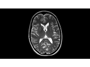 MultiVane XD — obrazowanie mózgu Zastosowania kliniczne obrazowania MR