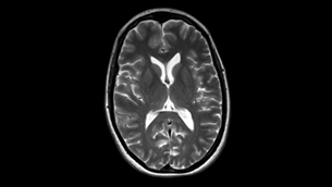 MultiVane XD - Brain