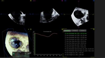 AI-based echo image of tricuspid valve
