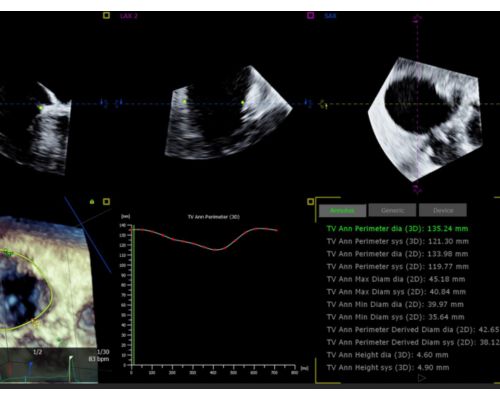 AI-driven tricuspid valve quantification to guide device selection
