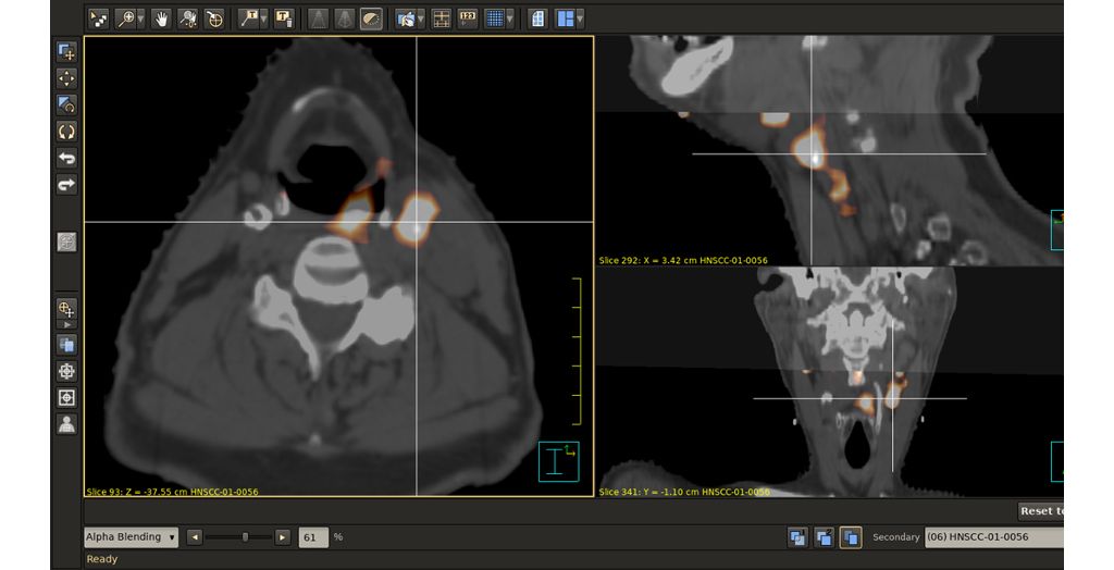 PET/CT image fusion assists in target delineation.
