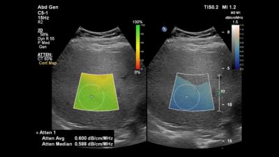 Màn hình hiển thị Philips Liver Fat Quantification attenuation imaging