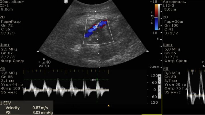 TomTec Vascular Measurements