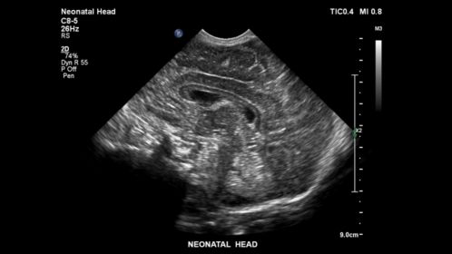 EPIQ ultrasound machine clinical image neonatal head