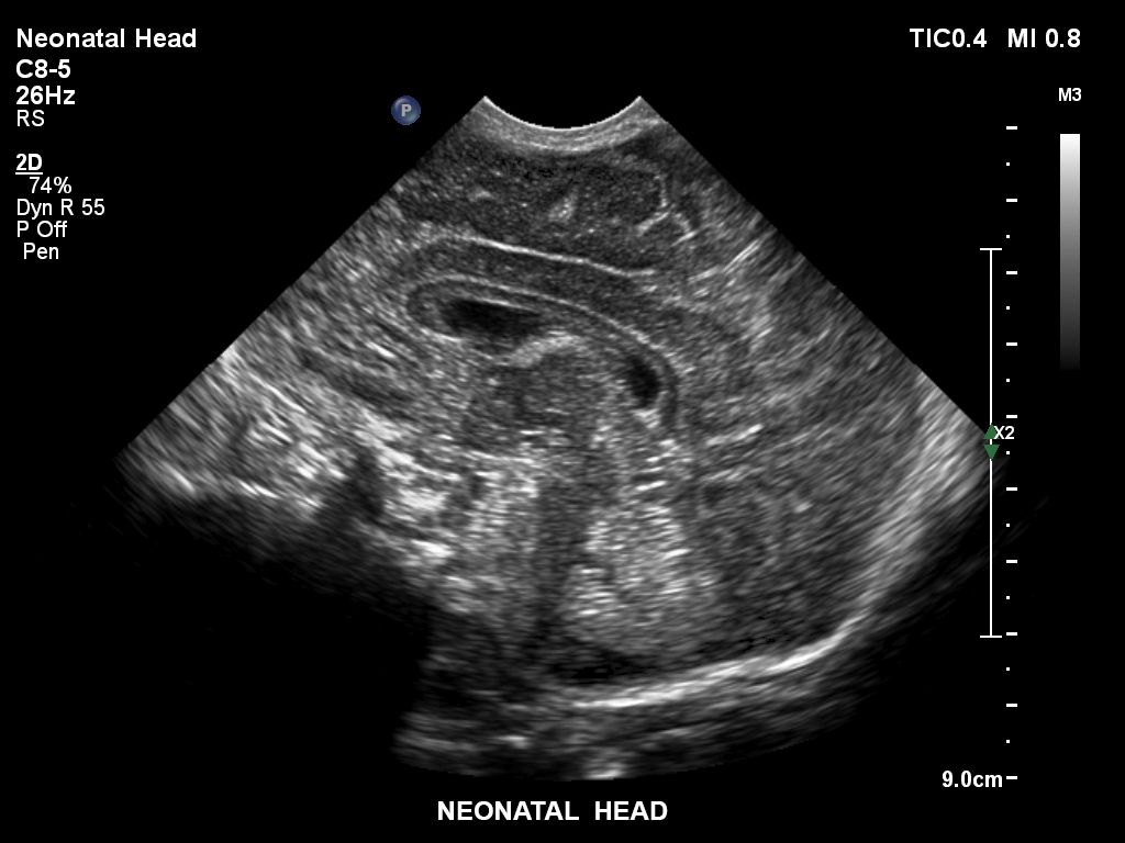 EPIQ ultrasound machine clinical image neonatal head