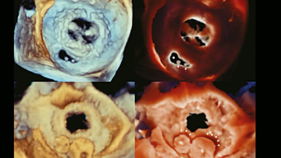 TrueVue - shadows projected by the vascular plugs on the mitral bioprosthesis