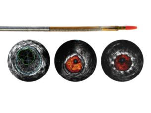 Reconnaissance PV .018 OTW Digital IVUS catheter