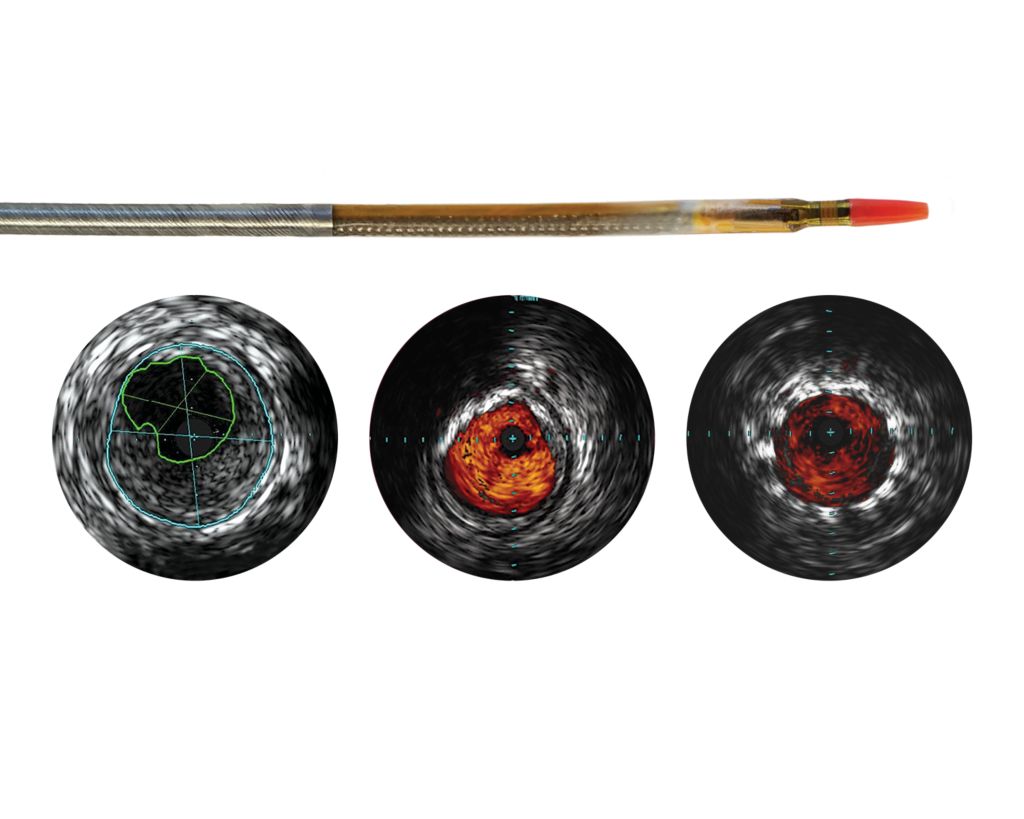Reconnaissance PV .018 OTW Digital IVUS catheter