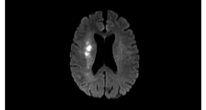 Diffusion Brain MR Clinical application | Philips