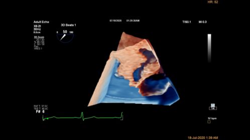 Live 3D TEE LA Appendage CV Ultrasound Imaging