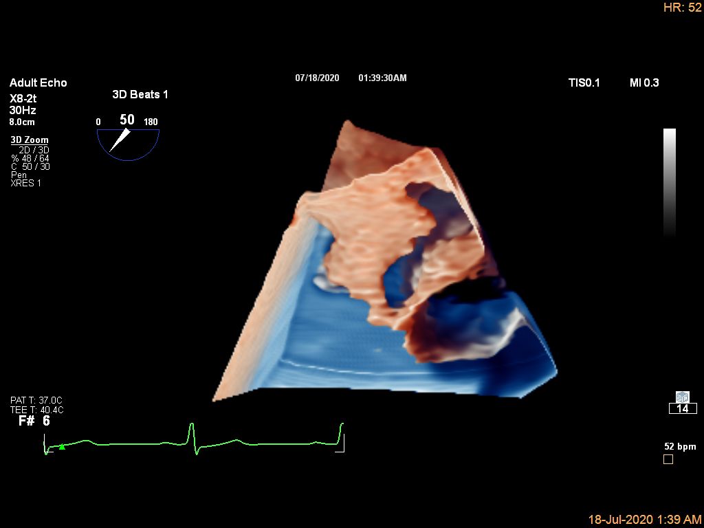 Live 3D TEE LA Appendage CV Ultrasound Imaging