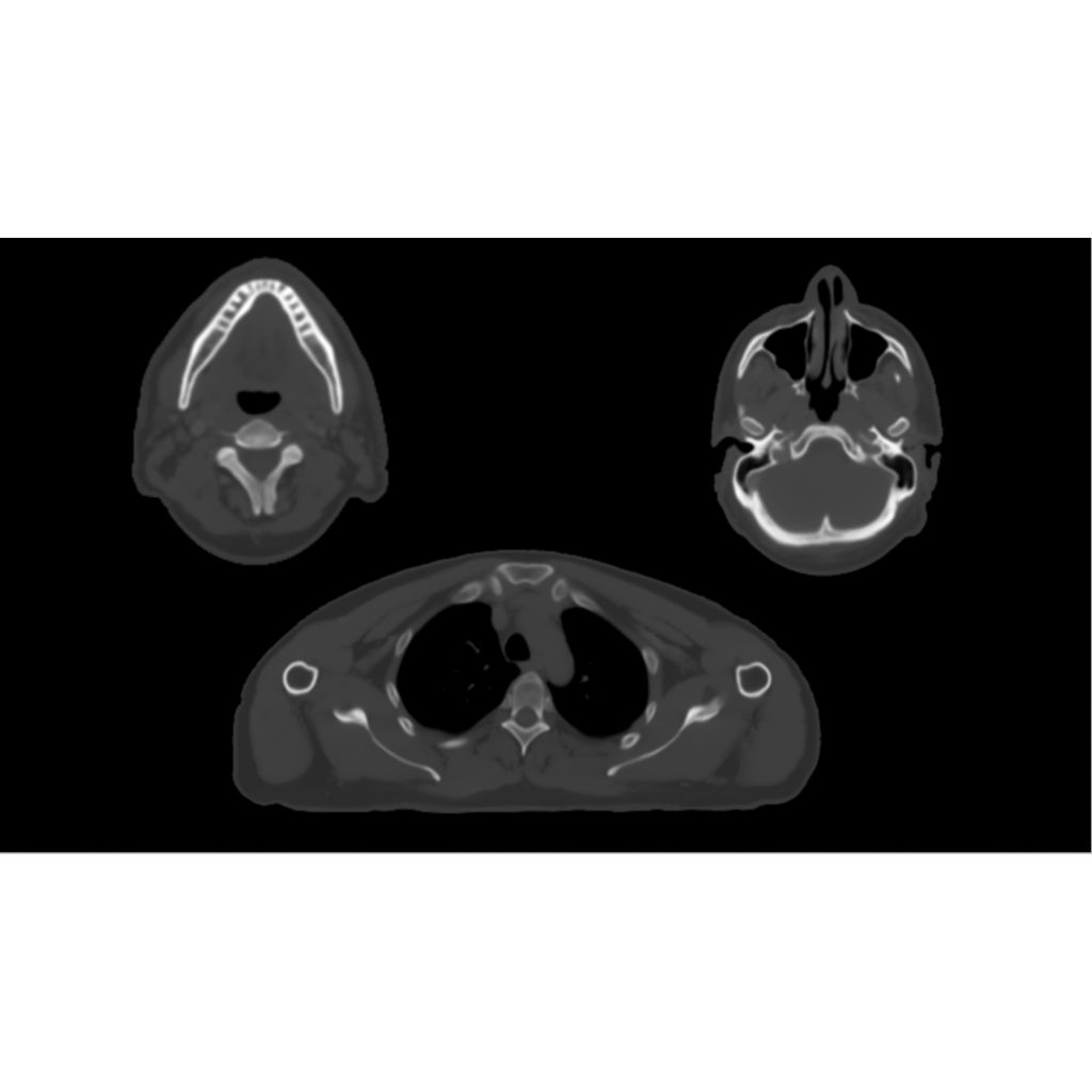 Synthetic CT images using AI