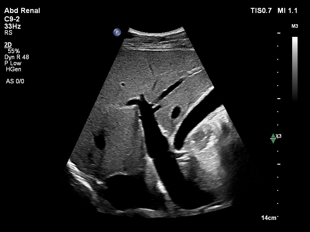 C9-2 scanning on the Abdomen Renal Preset
