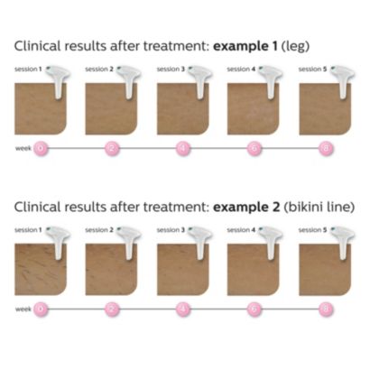 Philips Lumea Advanced