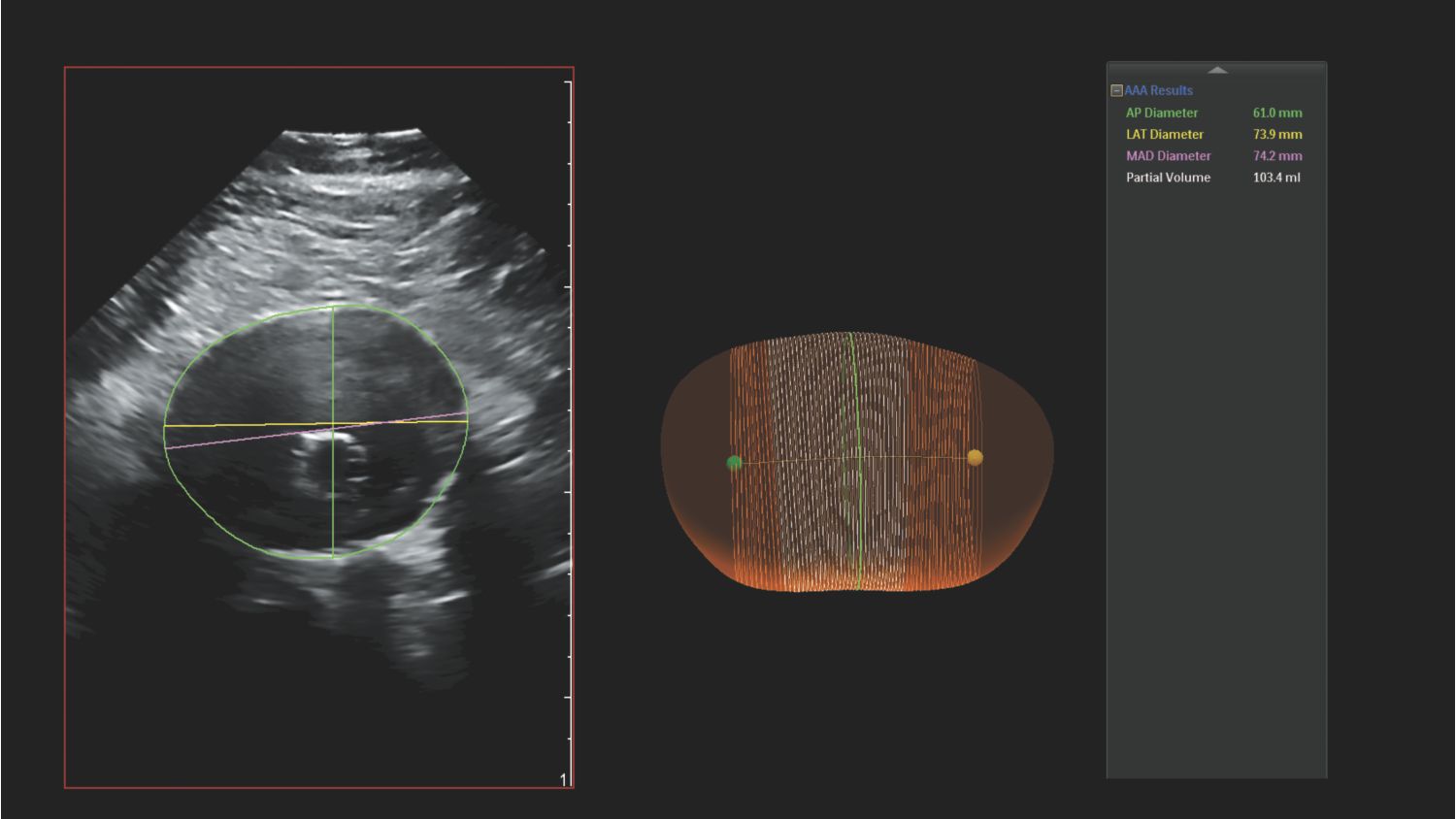 Clinical image of a Philips AAA model scan with anterior-to-posterior diameter and partial volume measurements