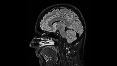 Sagittal 3D BrainVIEW FLAIR