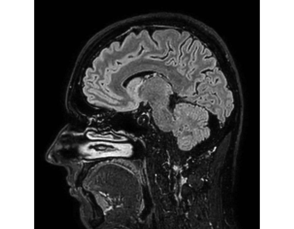 Sagittal 3D BrainVIEW FLAIR