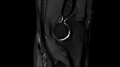 Sagittal PDw SPAIR TSE with DRIVE - Elbow