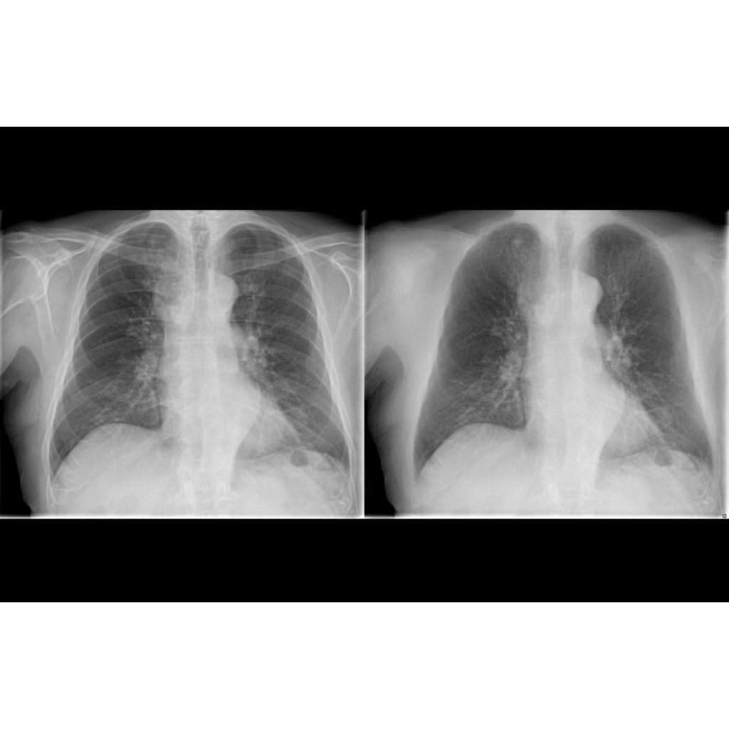 Improved lung nodule detection with Philips Bone Suppression