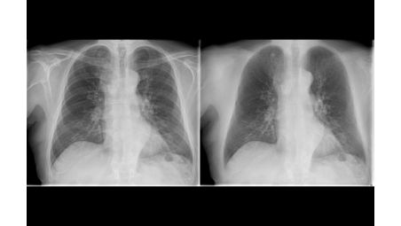 Improved lung nodule detection with Philips Bone Suppression