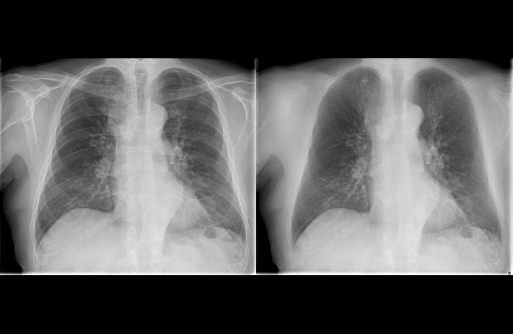 Improved lung nodule detection with Philips Bone Suppression