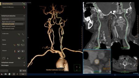 Fluxo de trabalho inovado de análise vascular projetado para um resultado mais rápido