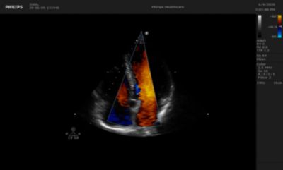 Adult echo video