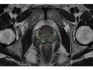Smart Reading QP-Prostate AI-based quantitative reporting for prostate cancer
