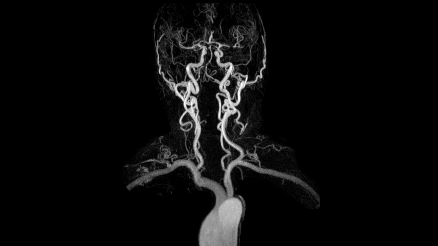 3D dynamic MRA of head and neck