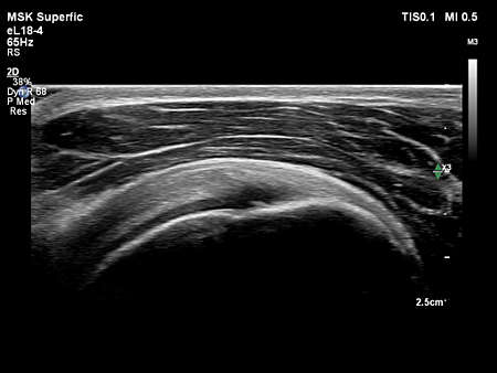 eL18-4 MSK Shoulder