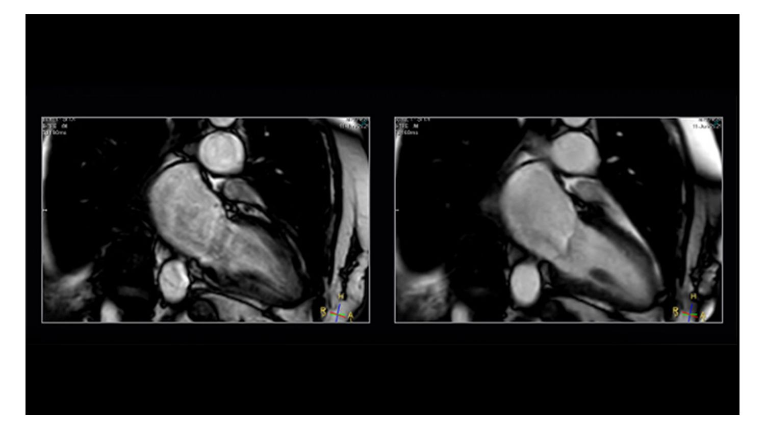   Long axis cine cardiac MR with Compressed SENSE 