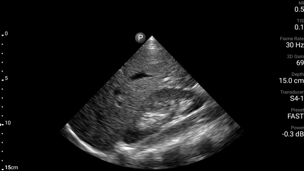 FAST exam RUQ view shown using S4-1 transducer.