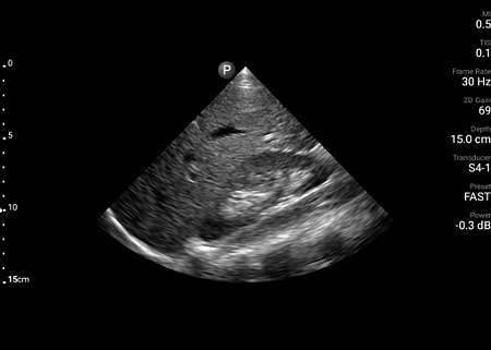FAST exam RUQ view shown using S4-1 transducer.