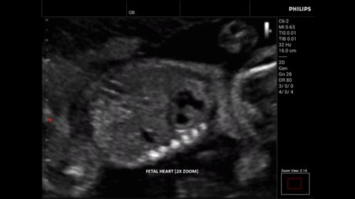 Innosight clinical image fetal heart
