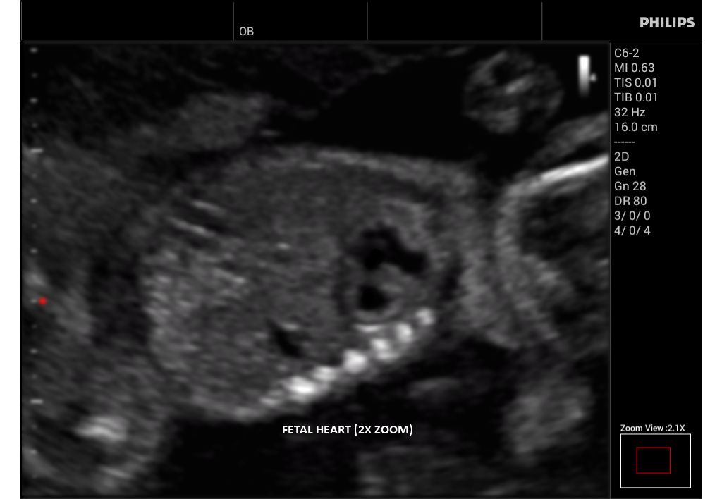 Innosight clinical image fetal heart