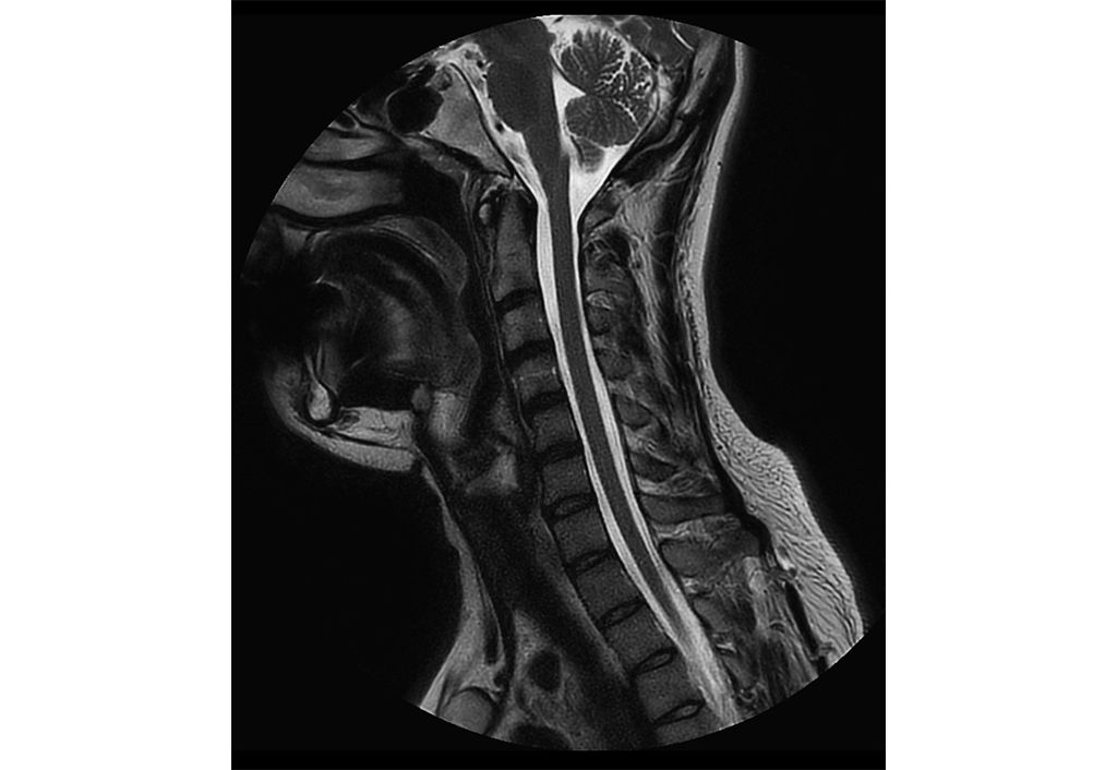 Sagittal T2w MultiVane XD