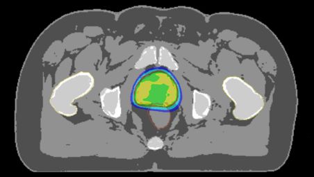 RTdrive MR Prostate