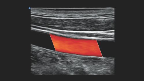 Longitudinal common carotid artery