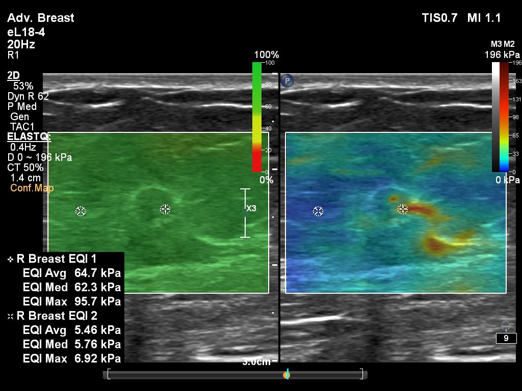 Linear ElastQ Breast