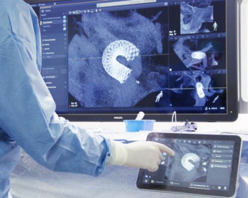 3D visualization beyond the clot