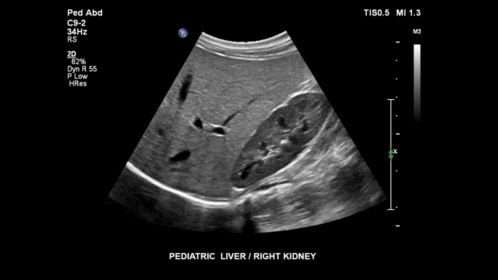 EPIQ ultrasound machine clinical image pediatric liver, right kidney