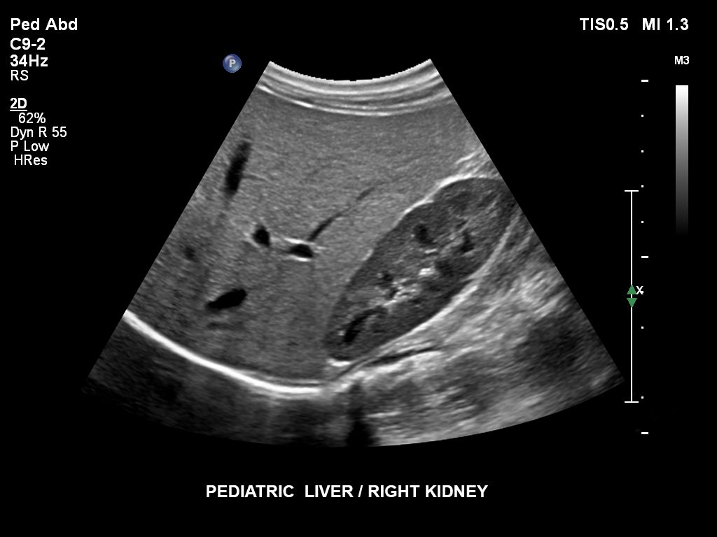 EPIQ ultrasound machine clinical image pediatric liver, right kidney